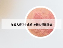 年轻人得了牛皮癣 年轻人得银屑病