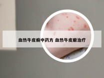 血热牛皮癣中药方 血热牛皮廨治疗