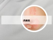 药癣高