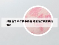 绿豆治了30年的牛皮癣 绿豆治疗银屑病的偏方