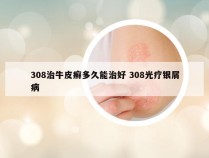308治牛皮癣多久能治好 308光疗银屑病
