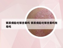 银屑病能吃银杏果吗 银屑病能吃银杏果吗有毒吗