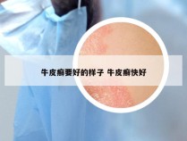 牛皮癣要好的样子 牛皮癣快好