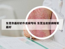 东莞市最好的牛皮癣专科 东莞治皮肤病哪家最好