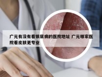 广元有没有看银屑病的医院地址 广元哪家医院看皮肤更专业