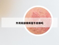 外阴局部瘙痒是牛皮癣吗