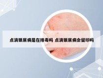 点滴银屑病是在排毒吗 点滴银屑病会留印吗