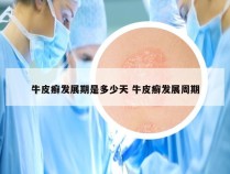 牛皮癣发展期是多少天 牛皮癣发展周期
