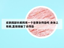 皮肤囤部长癣同用一个坐便会传染吗 身体上有癣,直接接触了会传染