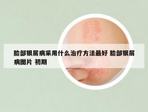 脸部银屑病采用什么治疗方法最好 脸部银屑病图片 初期