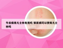 牛皮癣用凡士林有用吗 银屑病可以使用凡士林吗