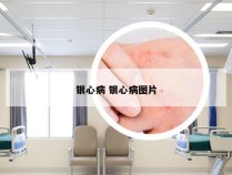 银心病 银心病图片