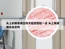 头上的银屑病怎样才能把他轻一点 头上银屑病会自愈吗