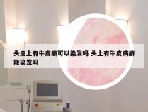 头皮上有牛皮癣可以染发吗 头上有牛皮病癣能染发吗