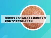 银屑病恢复后为什么晚上身上的红就退了 银屑病好了的地方为什么会发红