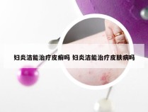 妇炎洁能治疗皮癣吗 妇炎洁能治疗皮肤病吗
