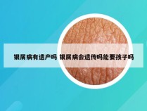 银屑病有遗产吗 银屑病会遗传吗能要孩子吗
