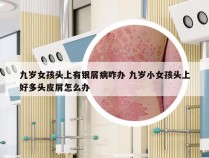 九岁女孩头上有银屑病咋办 九岁小女孩头上好多头皮屑怎么办