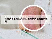 红皮病银屑病的病期 红皮病银屑病的鉴别诊断