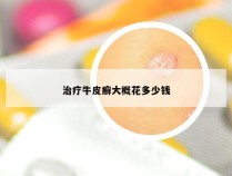 治疗牛皮癣大概花多少钱