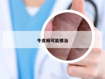 牛皮癣可能根治