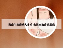 海南牛皮癣病人多吗 去海南治疗银屑病