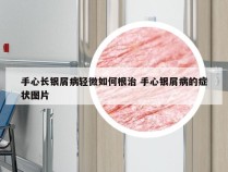 手心长银屑病轻微如何根治 手心银屑病的症状图片
