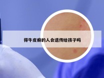 得牛皮癣的人会遗传给孩子吗