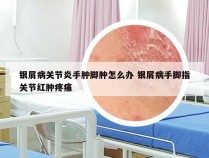 银屑病关节炎手肿脚肿怎么办 银屑病手脚指关节红肿疼痛