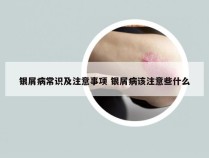 银屑病常识及注意事项 银屑病该注意些什么