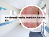 天津到哪里看牛皮癣好 天津看银屑病最好的医院