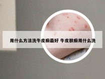 用什么方法洗牛皮癣最好 牛皮肤癣用什么洗