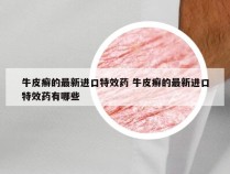 牛皮癣的最新进口特效药 牛皮癣的最新进口特效药有哪些