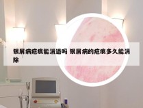银屑病疤痕能消退吗 银屑病的疤痕多久能消除