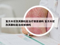 复方木尼孜其颗粒能治疗银屑病吗 复方木尼孜其颗粒能治皮肤病吗
