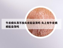 牛皮癣头发不挨头皮能染发吗 头上有牛皮病癣能染发吗
