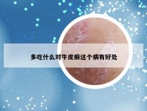 多吃什么对牛皮癣这个病有好处