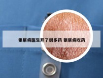 银屑病医生开了很多药 银屑病吃药