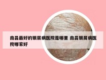 南昌最好的银屑病医院是哪里 南昌银屑病医院哪家好