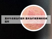重庆牛皮癣治疗医院 重庆治疗银屑病的权威医院
