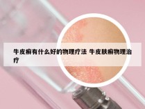 牛皮癣有什么好的物理疗法 牛皮肤癣物理治疗