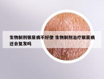 生物制剂银屑病不好使 生物制剂治疗银屑病还会复发吗
