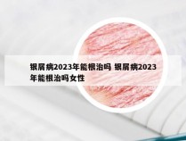 银屑病2023年能根治吗 银屑病2023年能根治吗女性