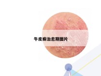 牛皮癣治愈期图片