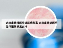 大连皮肤科医院银屑病专家 大连皮肤病医院治疗银屑病怎么样