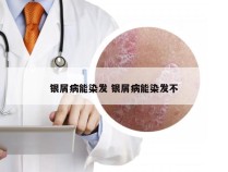 银屑病能染发 银屑病能染发不