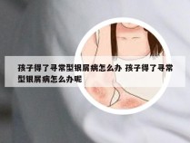 孩子得了寻常型银屑病怎么办 孩子得了寻常型银屑病怎么办呢