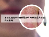 用明矾洗治疗牛皮癣管用吗 明矾治疗皮肤病有效果吗