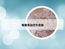 唧里有治疗牛皮癣