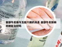 面部牛皮癣与五脏六腑的关系 面部牛皮肤癣初期能治好吗